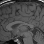 Infants with mild neonatal encephalopathy may be at risk for brain injury