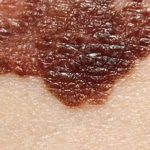 Nivolumab plus ipilimumab improves recurrence-free survival in patients with resected advanced melanoma