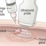 Fine needle biopsy remains a reliable test for thyroid cancer diagnosis