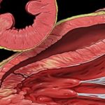 Percutaneous coronary intervention inefficacious in improving severe ischemic left ventricular dysfunction
