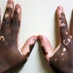 Ruxolitinib results in improved repigmentation as compared to vehicle-control in nonsegmental vitiligo