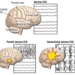 Angiotensin receptor blockers may reduce the incidence of epilepsy in patients with hypertension