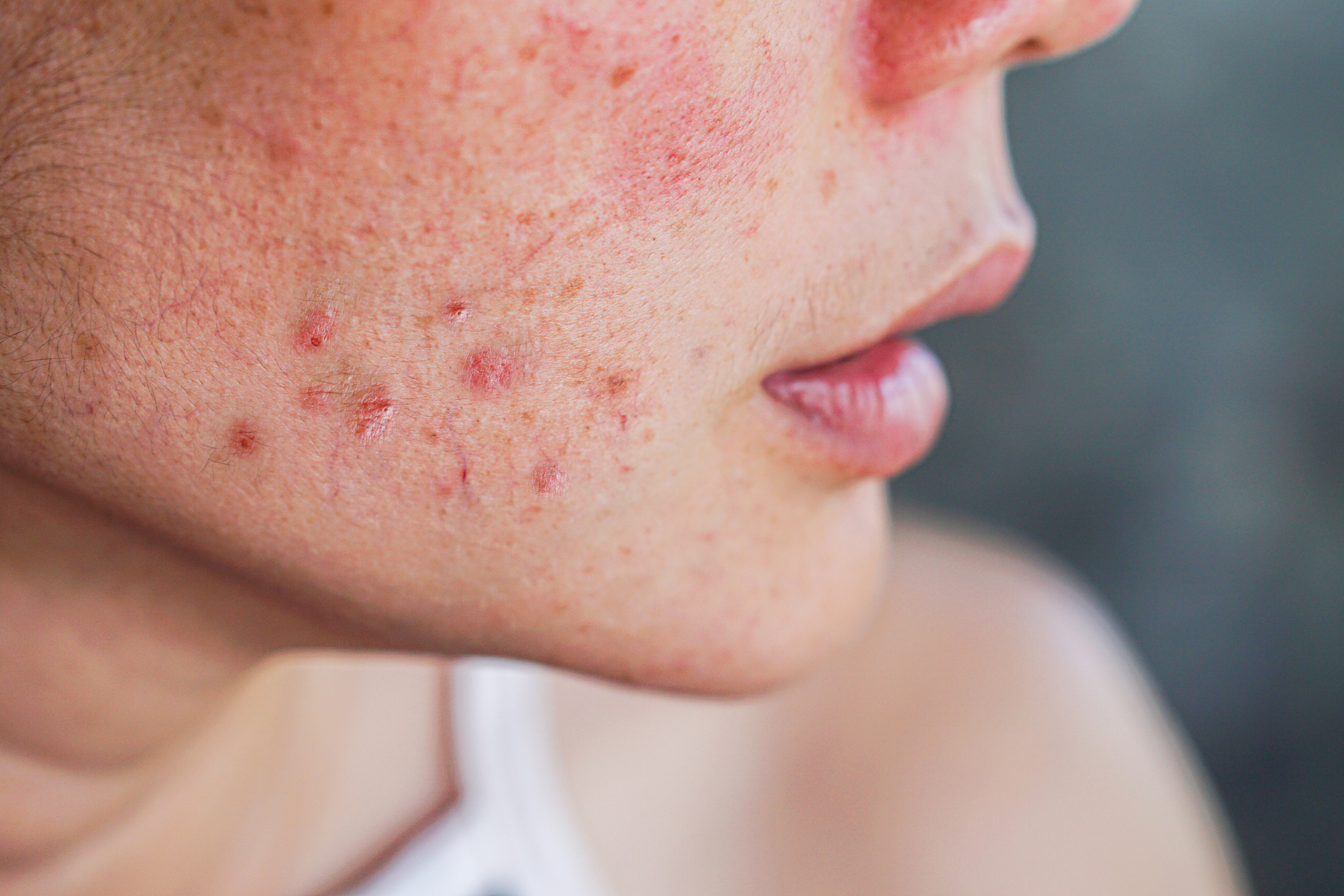 Atopic Dermatitis Patients Treated with Upadacitinib: Characterization of Acne