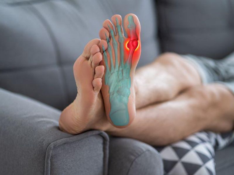 Changes in Metabolic Syndrome Linked to Alteration in Risk for Gout