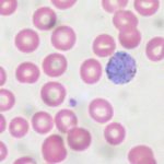 Monoclonal antibody CIS43LS efficacious in preventing malaria in Mali