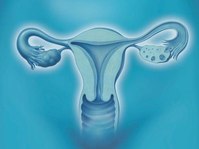Risk of Uterine Diseases, Cancers Up With Tamoxifen Treatment