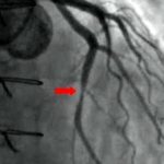 Bivalirudin during and post-percutaneous coronary intervention reduces bleeding and mortality compared to heparin monotherapy