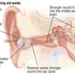 Use of restorative hearing aid devices improves cognition and reduces risk of dementia in patients with hearing loss