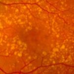 Meta-analysis shows significant decrease in age-related macular degeneration risk with metformin use