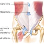 No significant differences in postoperative complications found between open repair with local anesthesia and laparoscopic repair of inguinal hernias