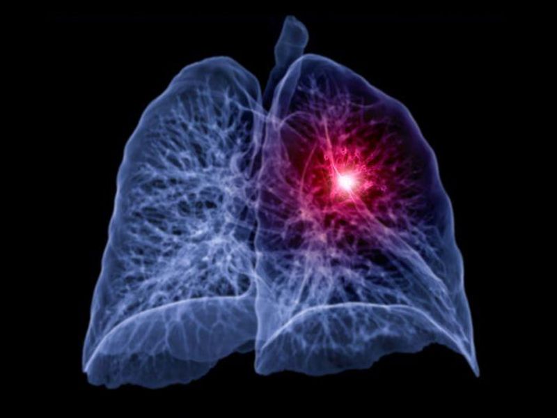 Model Can Accurately Predict Future Lung Cancer Risk From Low-Dose CT
