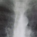 Chronic obstructive pulmonary disease associated with worse postoperative outcomes
