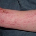 Rocatinlimab may be effective in the treatment of moderate-to-severe atopic dermatitis