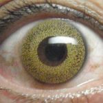 Risk of hydroxychloroquine retinopathy increases with longer use and higher dosage