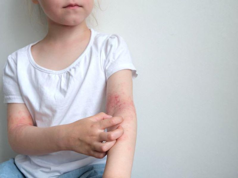 Global Prevalence of Eczema Estimated for Children, Teens