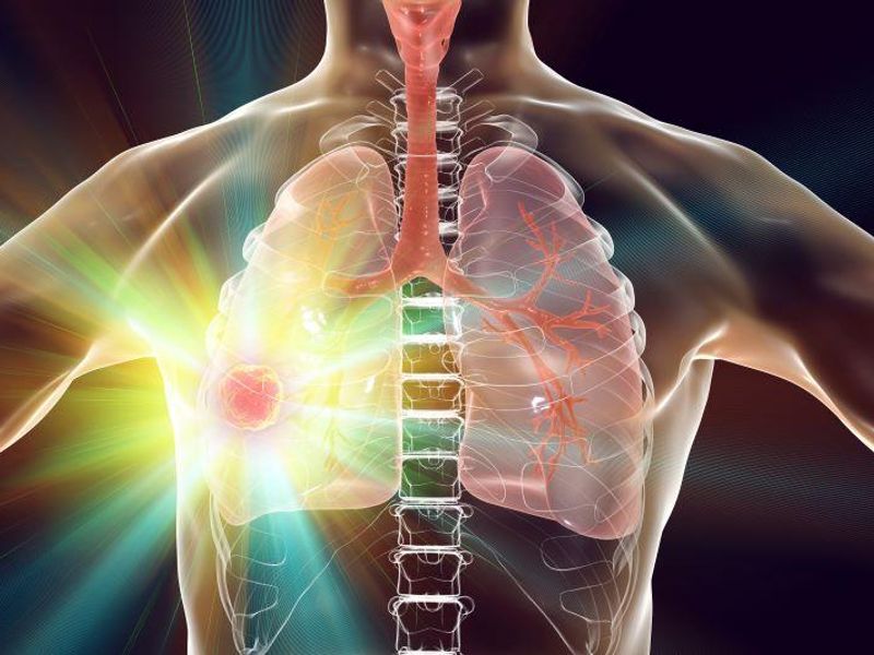 Positive Five-Year Outcomes Seen for Nivolumab in Resectable Lung Cancer