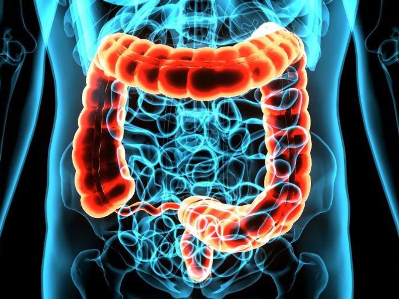 Adenoma Detection Rate Inversely Linked to Postcolonoscopy CRC