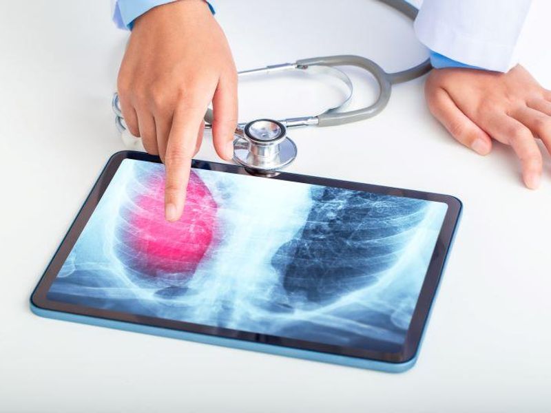 AI Has High Sensitivity for Abnormal Chest Radiographs