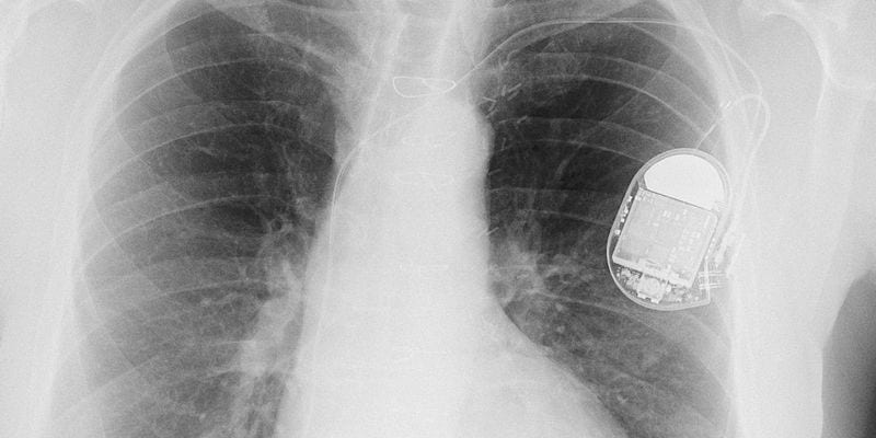Video decision support tool improves knowledge in Black implantable cardioverter-defibrillator candidates