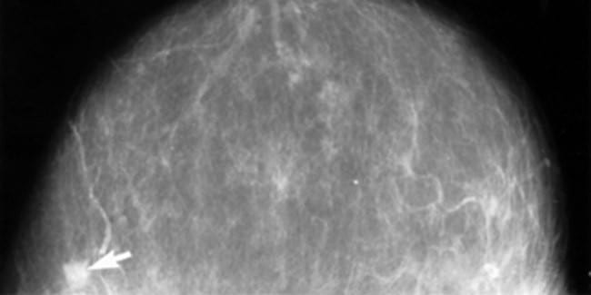 Measuring the rate of change of breast density over time may help to refine breast cancer screening