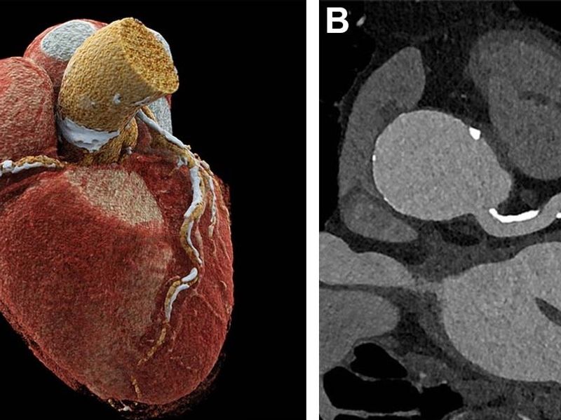 Ultrahigh-Resolution CCTA Has High Diagnostic Accuracy for Coronary Artery Disease