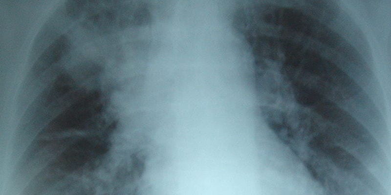 Hydrocortisone reduces mortality in severe community-acquired pneumonia