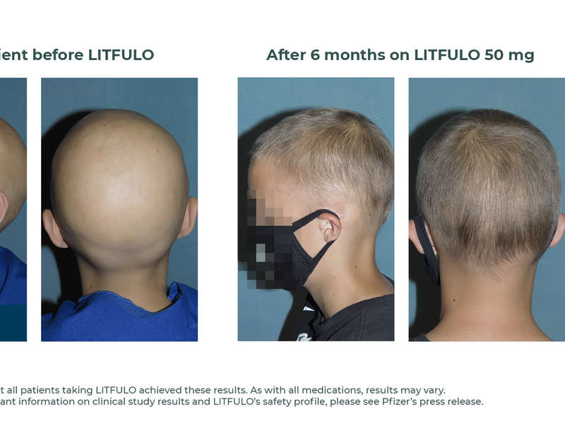 FDA Approves Litfulo for Teens, Adults With Alopecia Areata