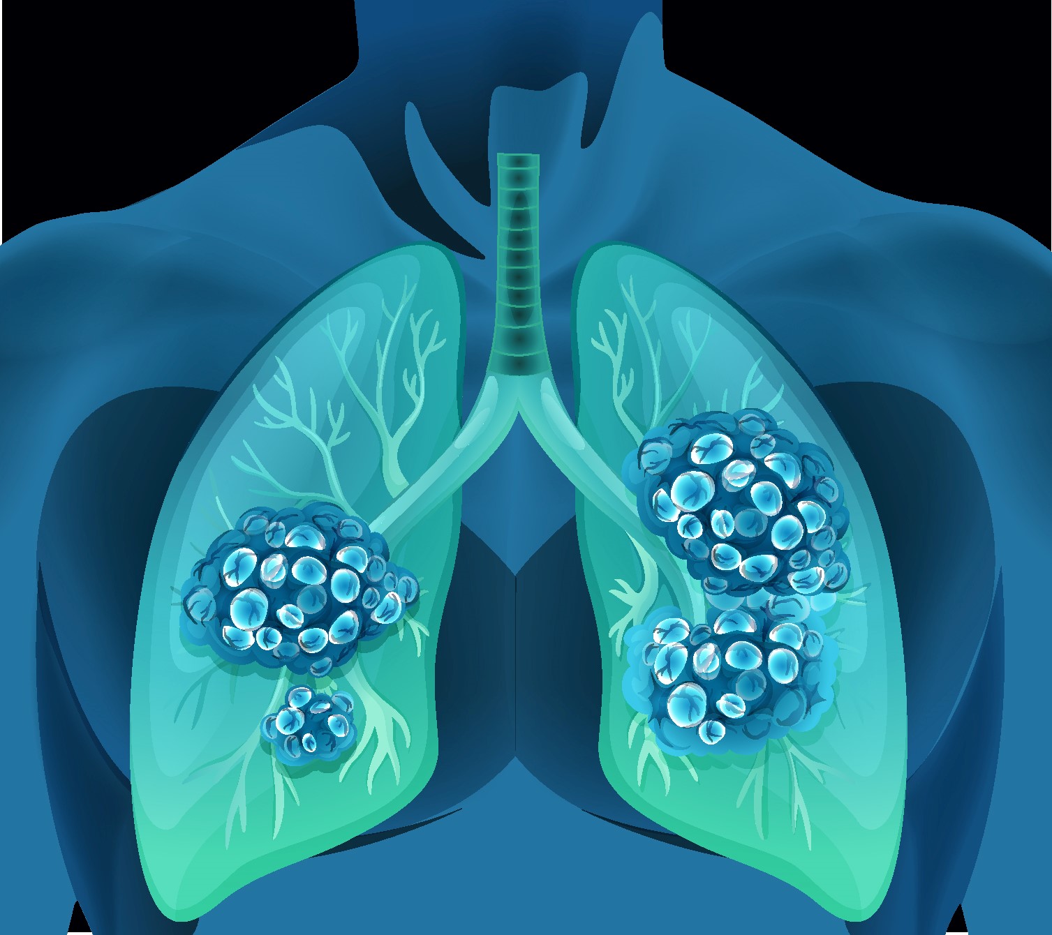 Critically Ill Apparently Immunocompetent Patients With Invasive Pulmonary Aspergillosis