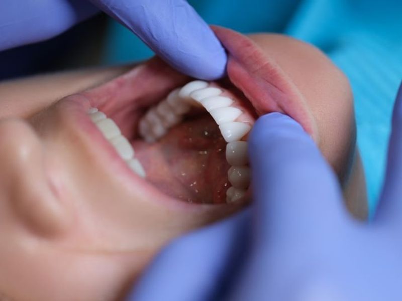 Prolonged Time to Postop Radiation Linked to Worse Survival in Oral Cavity Cancer