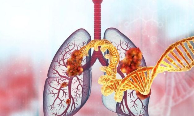 Plasma ctDNA Genotyping Can Accelerate Time to Treatment for NSCLC