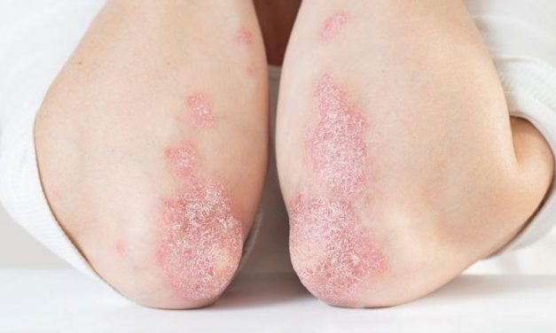 Low Vitamin D Levels Tied to Higher Severity of Psoriasis