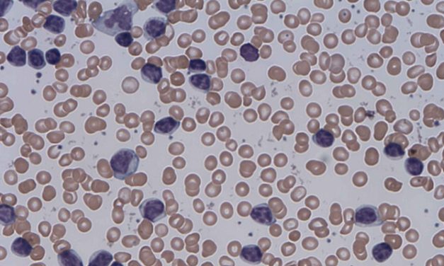 Lisocabtagene maraleucel may induce remission in relapsed chronic lymphocytic leukemia (CLL)