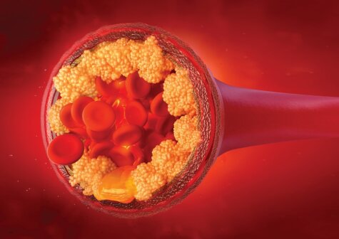 Exploring Non-HDL Cholesterol as a Predictor of Cardiovascular Events