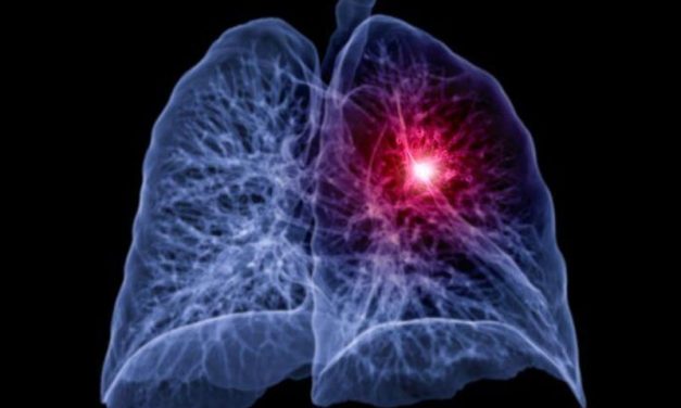 Intensity-Modulated Radiation Therapy Best for Locally Advanced NSCLC