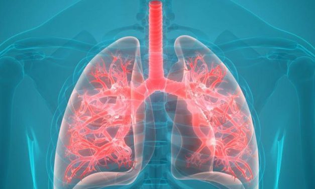 Sputum Purulence Can Predict Outcomes in Bronchiectasis