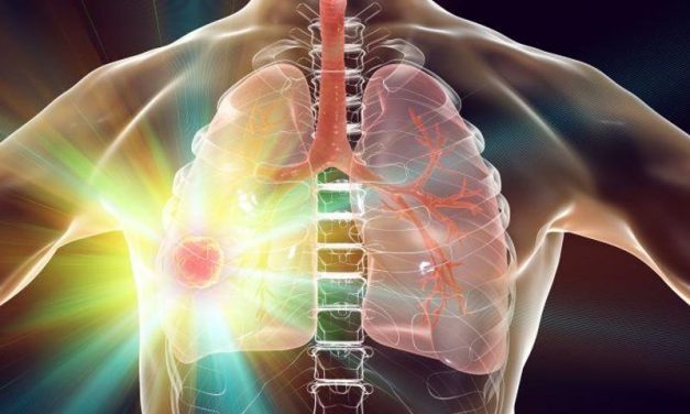 Social Disadvantage Tied to Worse Lung Cancer Outcomes