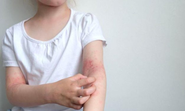 Children With Eczema More Likely to Have Allergic Contact Dermatitis