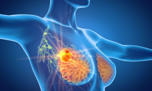ASTRO: Hypofractionation Effective for Radiotherapy After Breast Reconstruction