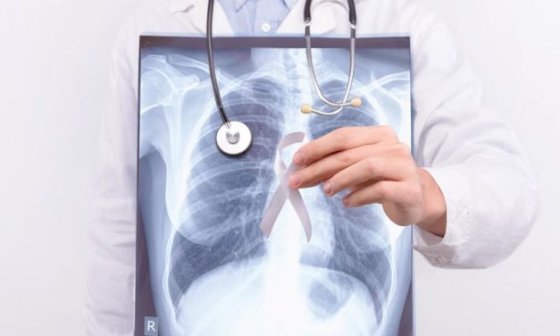 Incidence of Lung Cancer Higher in Women Versus Men Aged 35 to 54 Years
