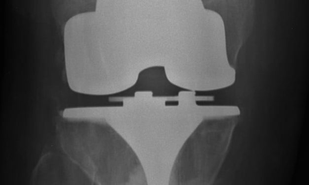 Recovery of knee function from total knee arthroplasty associated with improvement in depression symptoms
