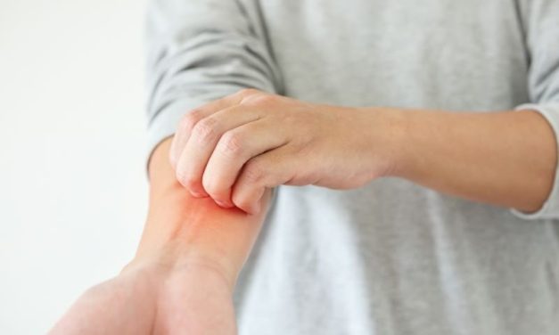 Recommendations Developed for Atopic Dermatitis Therapies