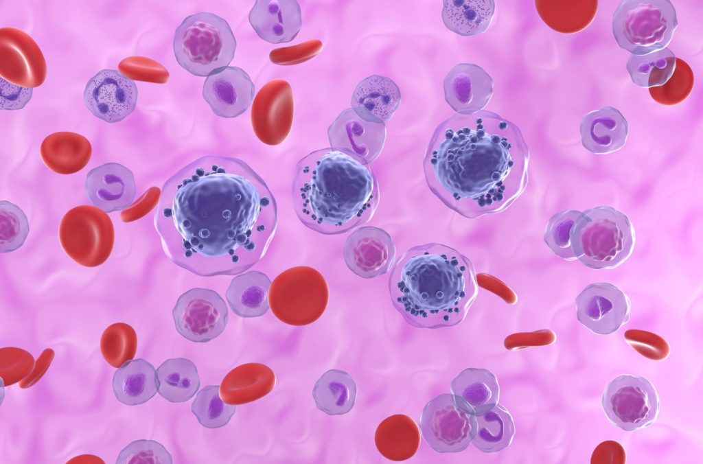 Acute myeloid leukemia cells in blood flow oncology hematology