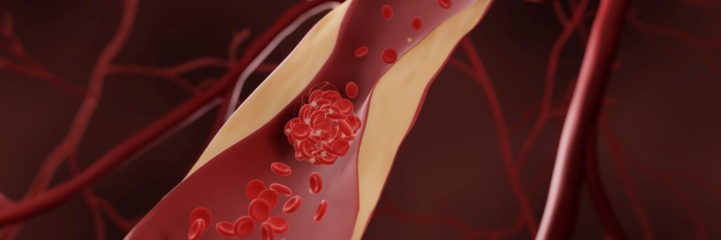 Atherosclerosis graphic illustration, ASCVD, cardiology, cardiosvascular disease