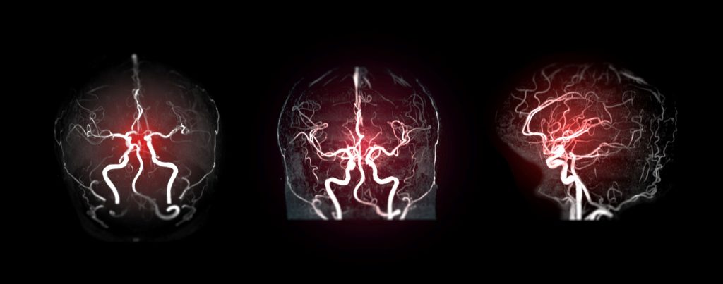 Collection of MRA brain or Magnetic resonance angiography image, ischemia, stroke, neurology, epilepsy