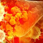 SBRT, Liver damage Fatty liver, Fibrosis, Cirrhosis Liver cancer oncology