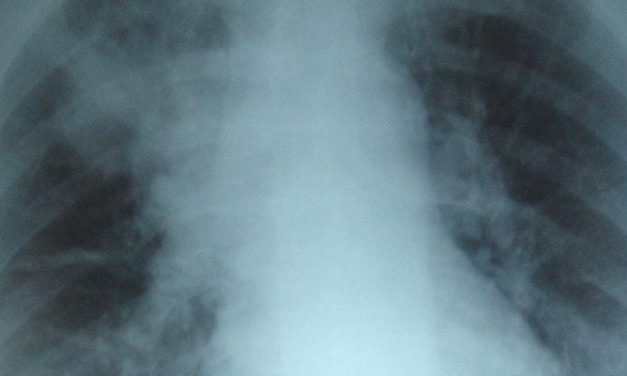 Point-of-care polymerase chain reaction may help guide antibiotic choice for pneumonia treatment