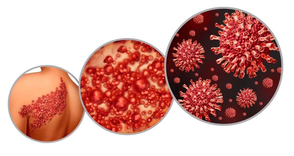 3 images of Herpes Zoster, shingles, infectious disease, illustration