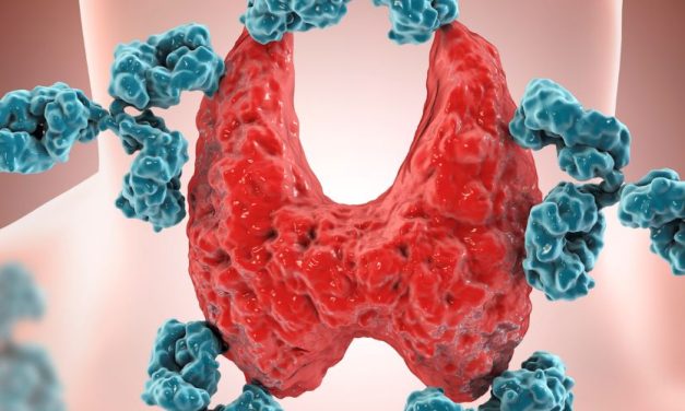 Total Thyroidectomy Provides Lasting Benefit for Hashimoto Disease