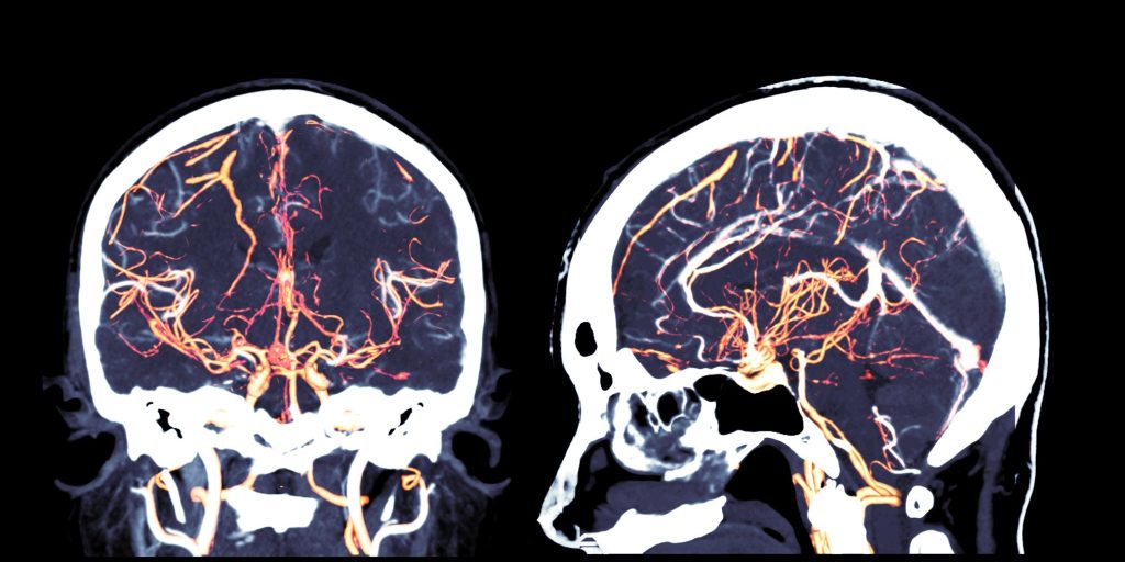 CT angiography of the brain coronal and sagittal view showing vessels in human head. CTA, Neurology, photo