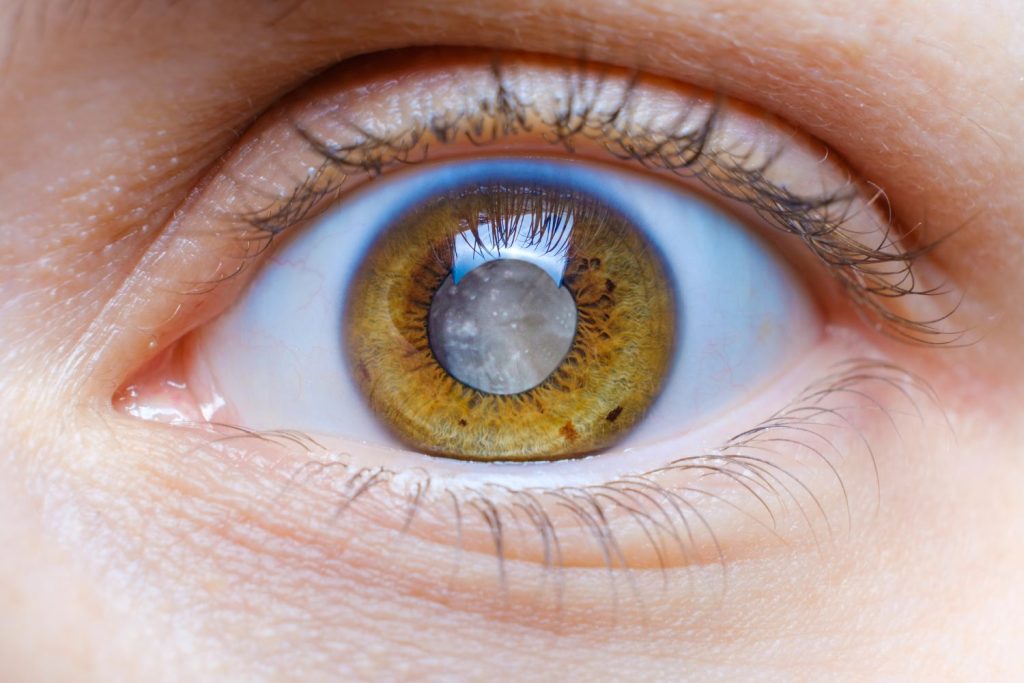 Closeup of human eye with clouded lens, white pupil, cataract, ophthalmology, photo
